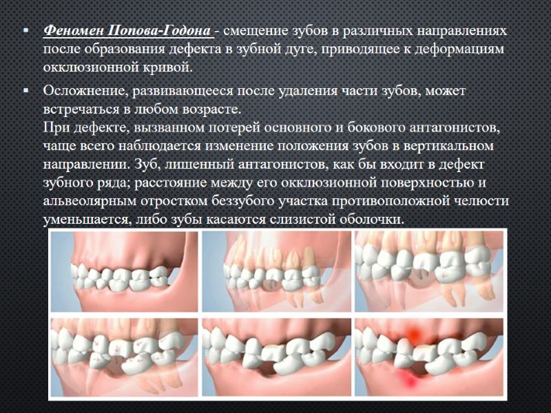 Феномен Попова-Годона - смещение зубов в различных направлениях после образования дефекта в зубной дуге,